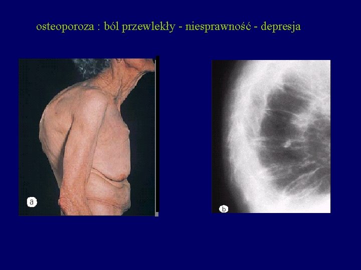 osteoporoza : ból przewlekły - niesprawność - depresja 
