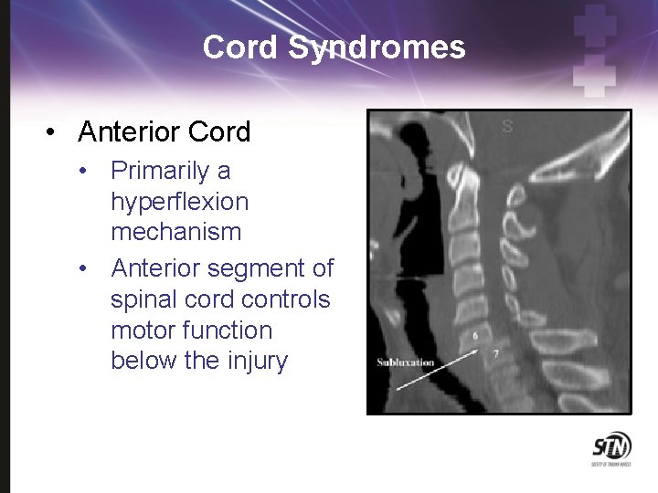 Cord Syndromes • Anterior Cord • Primarily a hyperflexion mechanism • Anterior segment of