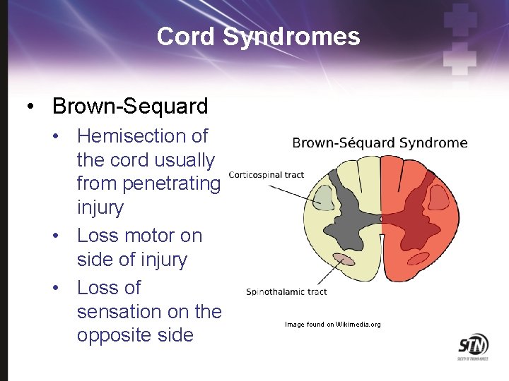 Cord Syndromes • Brown-Sequard • Hemisection of the cord usually from penetrating injury •
