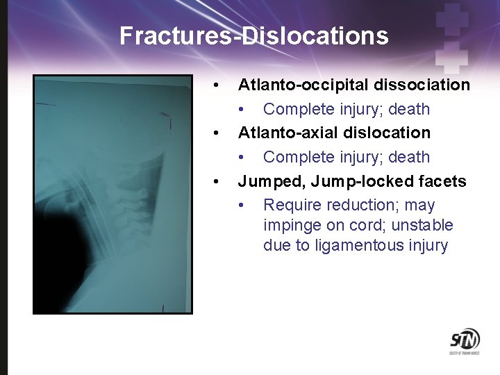 Fractures-Dislocations • • • Atlanto-occipital dissociation • Complete injury; death Atlanto-axial dislocation • Complete