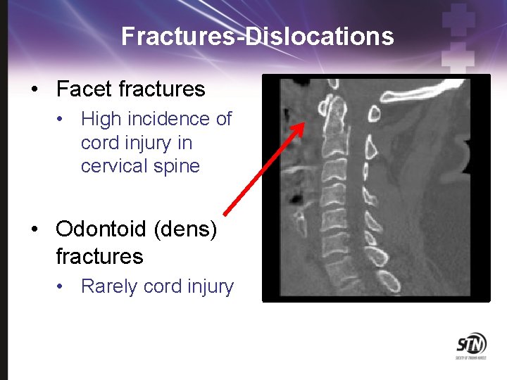 Fractures-Dislocations • Facet fractures • High incidence of cord injury in cervical spine •