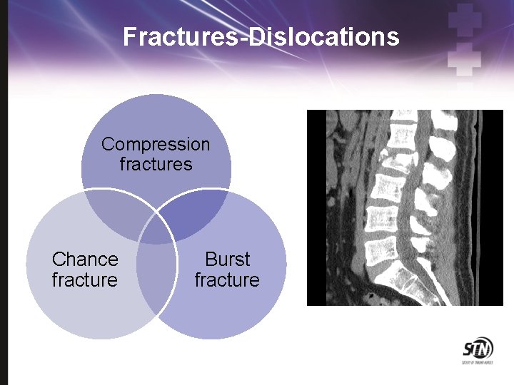 Fractures-Dislocations Compression fractures Chance fracture Burst fracture 