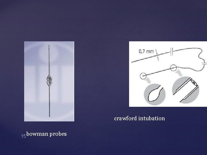 crawford intubation 15 bowman probes 