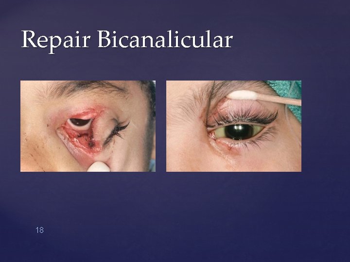 Repair Bicanalicular 18 