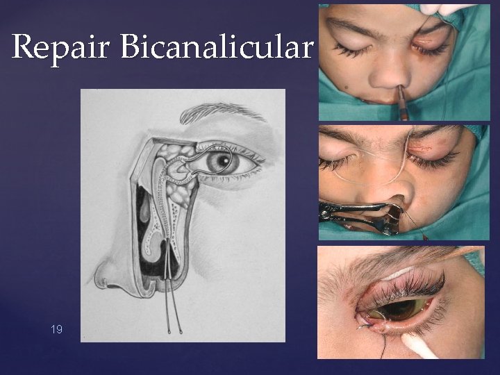 Repair Bicanalicular 19 