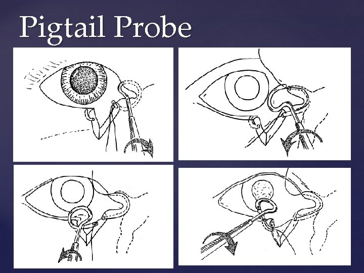 Pigtail Probe 