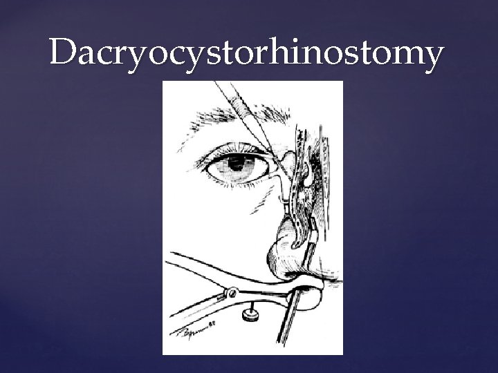 Dacryocystorhinostomy 