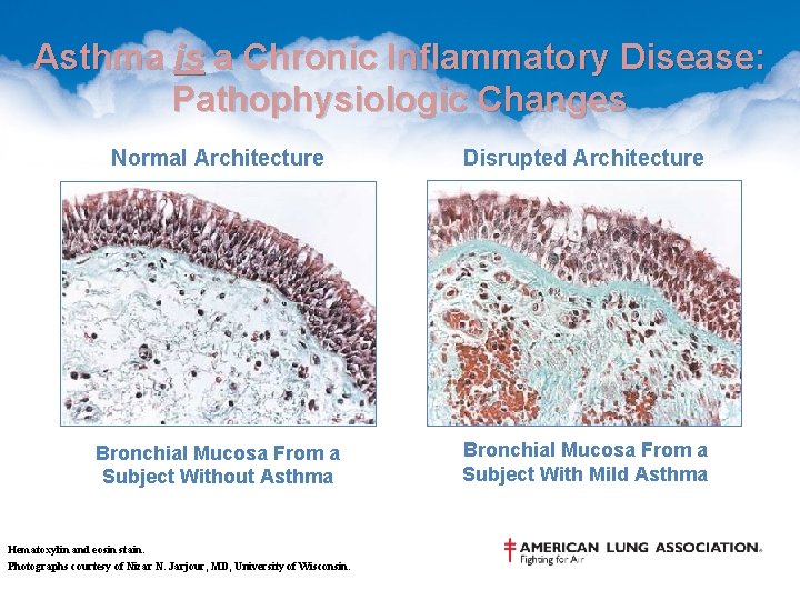 Asthma is a Chronic Inflammatory Disease: Pathophysiologic Changes Normal Architecture Disrupted Architecture Bronchial Mucosa