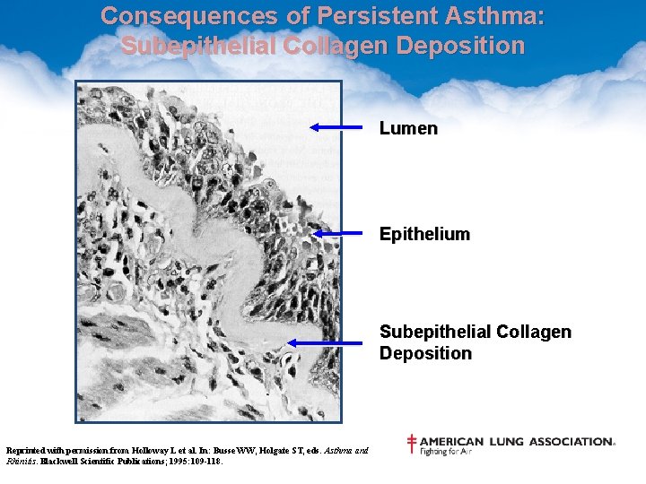 Consequences of Persistent Asthma: Subepithelial Collagen Deposition Lumen Epithelium Subepithelial Collagen Deposition Reprinted with