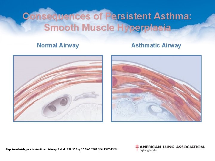 Consequences of Persistent Asthma: Smooth Muscle Hyperplasia Normal Airway Reprinted with permission from Solway