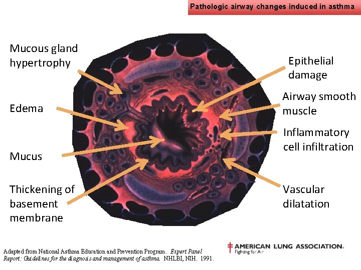 Pathologic airway changes induced in asthma Mucous gland hypertrophy Edema Mucus Thickening of basement