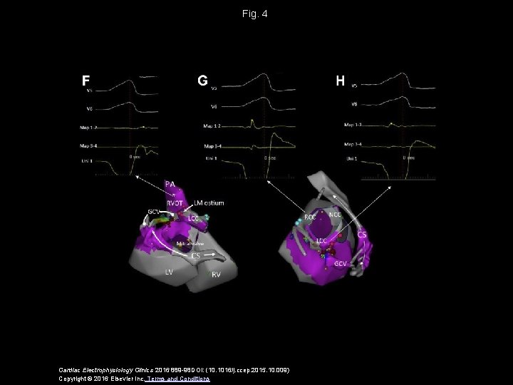 Fig. 4 Cardiac Electrophysiology Clinics 2016 889 -98 DOI: (10. 1016/j. ccep. 2015. 10.