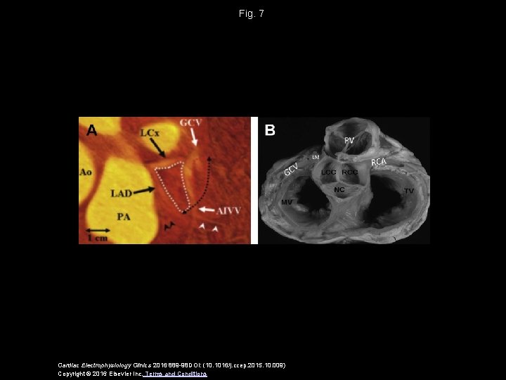 Fig. 7 Cardiac Electrophysiology Clinics 2016 889 -98 DOI: (10. 1016/j. ccep. 2015. 10.