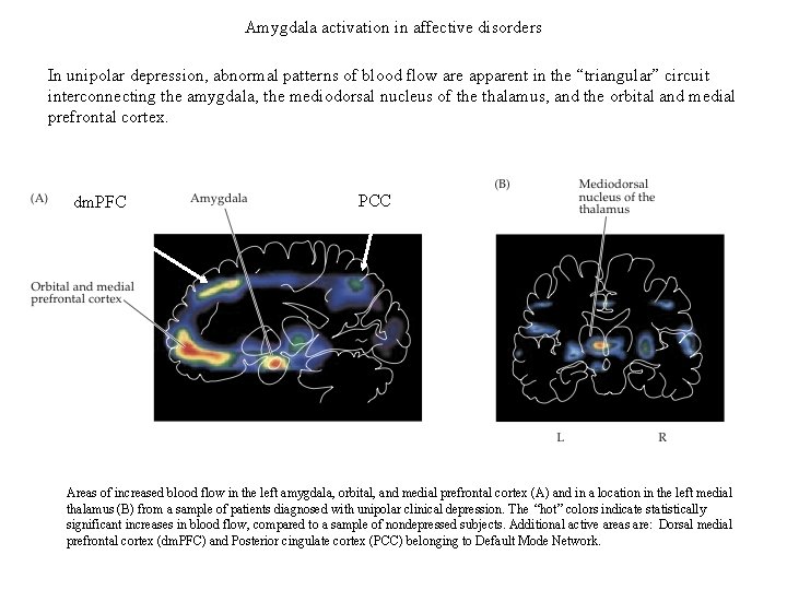 Amygdala activation in affective disorders In unipolar depression, abnormal patterns of blood flow are