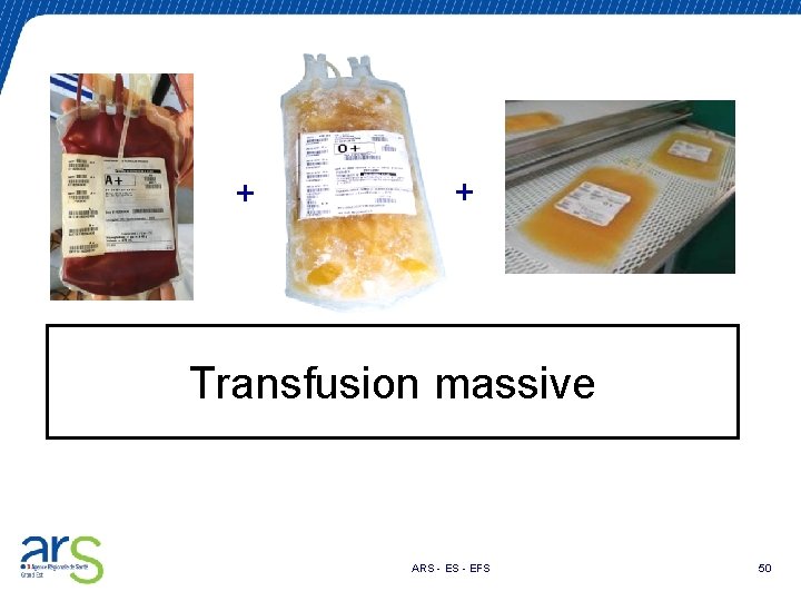 + + Transfusion massive ARS - EFS 50 