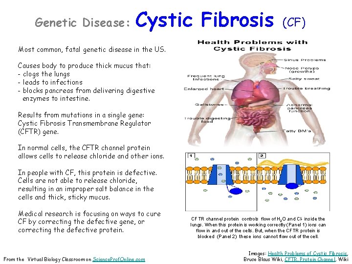 Genetic Disease: Cystic Fibrosis (CF) Most common, fatal genetic disease in the US. Causes