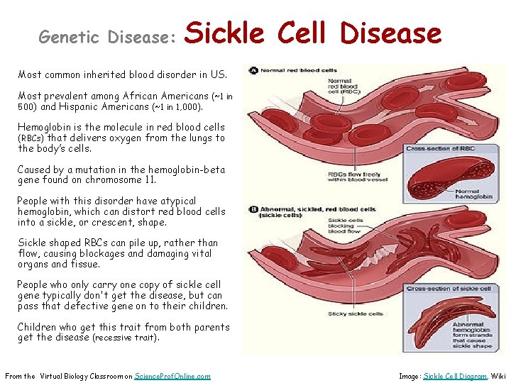 Genetic Disease: Sickle Cell Disease Most common inherited blood disorder in US. Most prevalent