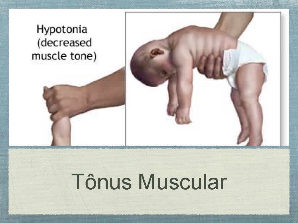 Tônus Muscular 