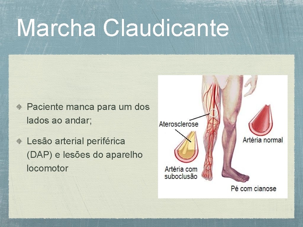 Marcha Claudicante Paciente manca para um dos lados ao andar; Lesão arterial periférica (DAP)