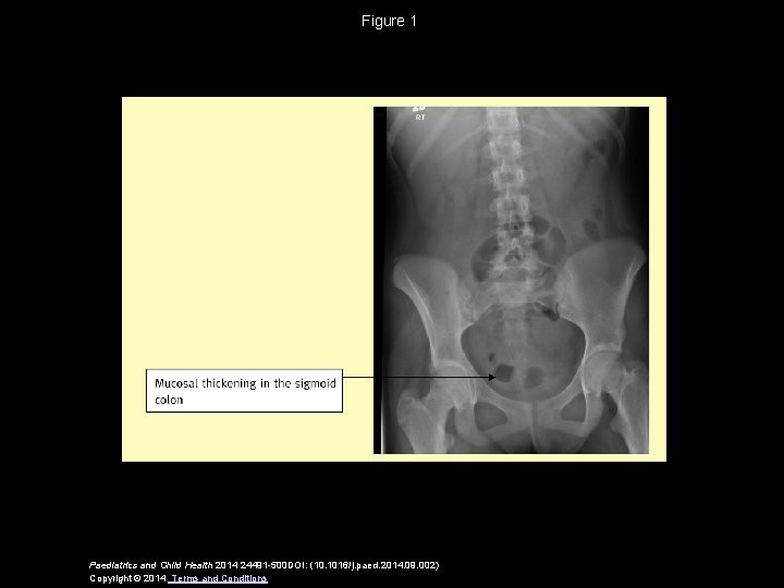 Figure 1 Paediatrics and Child Health 2014 24491 -500 DOI: (10. 1016/j. paed. 2014.