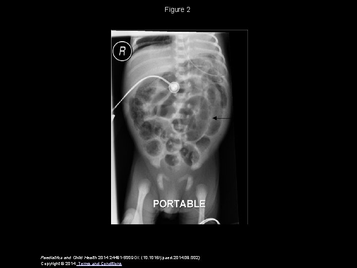 Figure 2 Paediatrics and Child Health 2014 24491 -500 DOI: (10. 1016/j. paed. 2014.