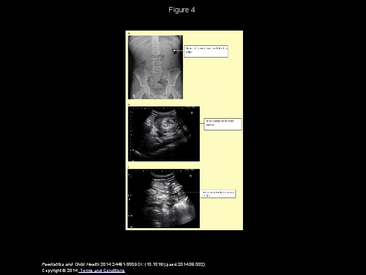 Figure 4 Paediatrics and Child Health 2014 24491 -500 DOI: (10. 1016/j. paed. 2014.