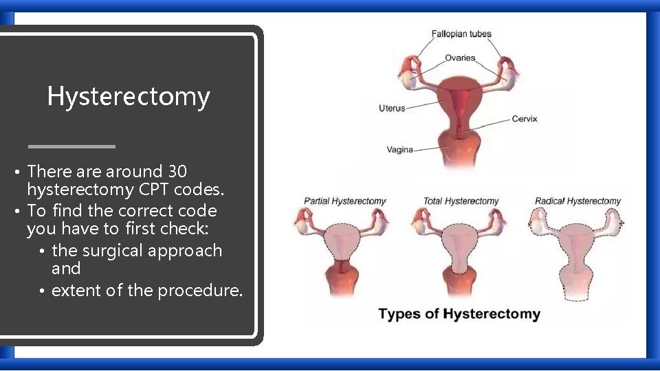 Hysterectomy • There around 30 hysterectomy CPT codes. • To find the correct code