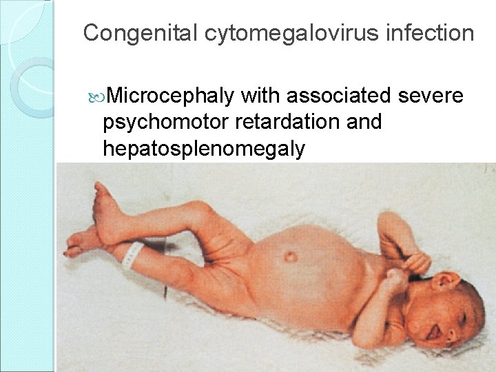 Congenital cytomegalovirus infection Microcephaly with associated severe psychomotor retardation and hepatosplenomegaly 
