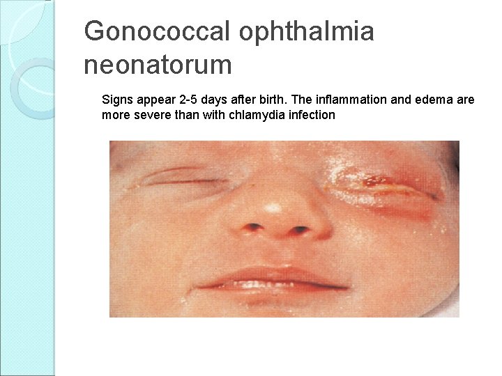 Gonococcal ophthalmia neonatorum Signs appear 2 -5 days after birth. The inflammation and edema