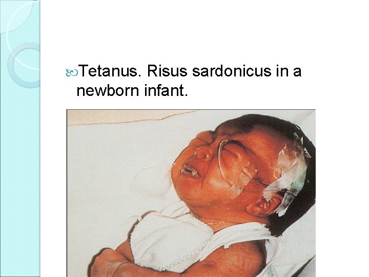 Tetanus. Risus sardonicus in a newborn infant. 