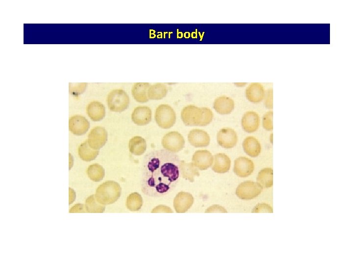 Barr body Barr body