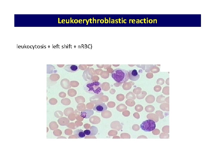 Leukoerythroblastic reaction leukocytosis + left shift + n. RBC) Leukoerythroblastic reaction leukocytosis + left shift + n. RBC)