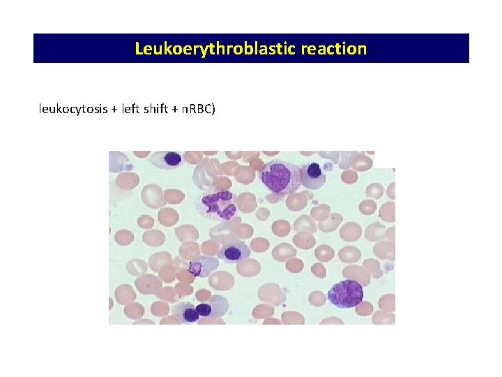 Leukoerythroblastic reaction leukocytosis + left shift + n. RBC) 