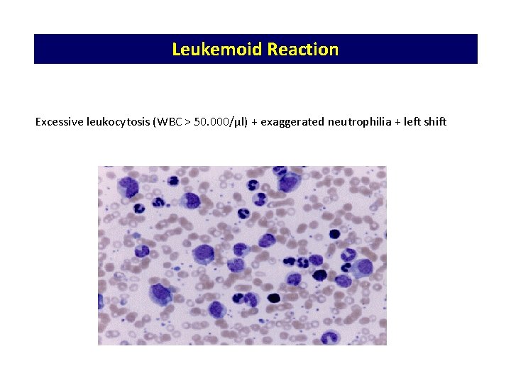 Leukemoid Reaction Excessive leukocytosis (WBC > 50. 000/μl) + exaggerated neutrophilia + left shift Leukemoid Reaction Excessive leukocytosis (WBC > 50. 000/μl) + exaggerated neutrophilia + left shift
