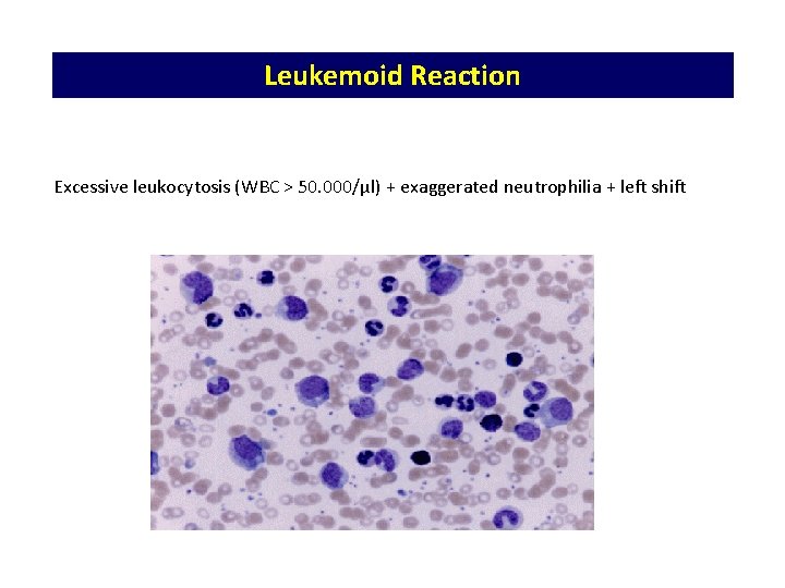 Leukemoid Reaction Excessive leukocytosis (WBC > 50. 000/μl) + exaggerated neutrophilia + left shift