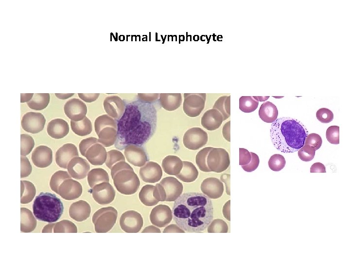 Normal Lymphocyte Normal Lymphocyte