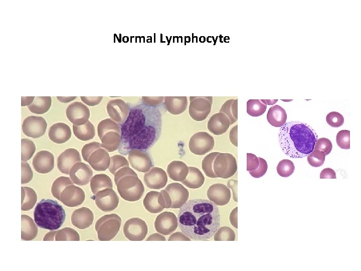 Normal Lymphocyte 