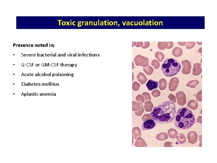 Toxic granulation, vacuolation Presence noted in; • Severe bacterial and viral infections • G-CSF