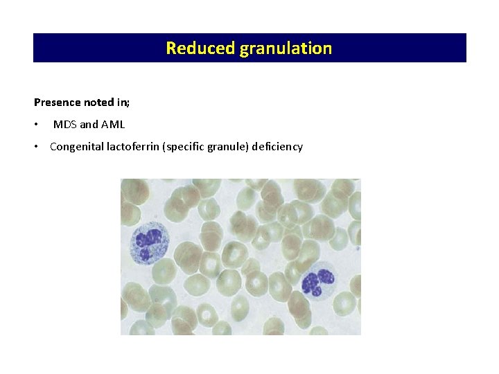 Reduced granulation Presence noted in; • MDS and AML • Congenital lactoferrin (specific granule) Reduced granulation Presence noted in; • MDS and AML • Congenital lactoferrin (specific granule)
