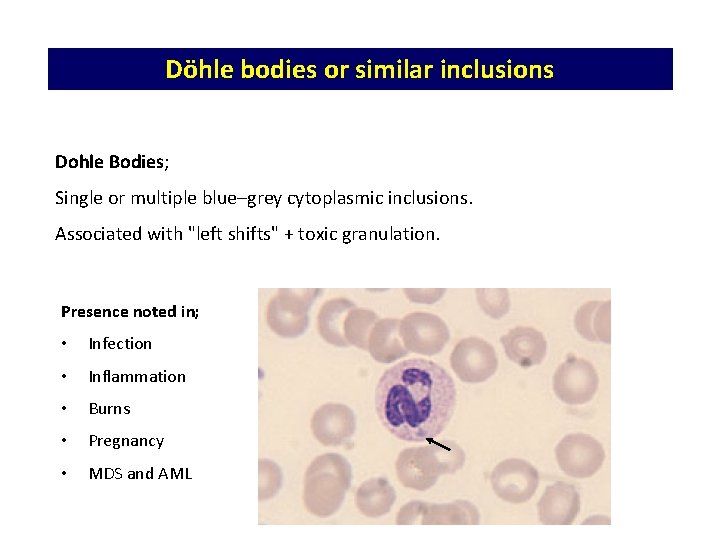 Döhle bodies or similar inclusions Dohle Bodies; Single or multiple blue–grey cytoplasmic inclusions. Associated Döhle bodies or similar inclusions Dohle Bodies; Single or multiple blue–grey cytoplasmic inclusions. Associated