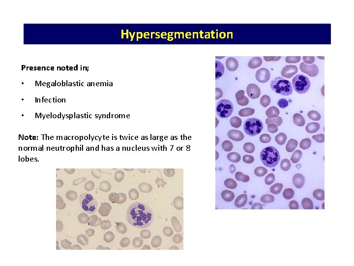 Hypersegmentation Presence noted in; • Megaloblastic anemia • Infection • Myelodysplastic syndrome Note: The Hypersegmentation Presence noted in; • Megaloblastic anemia • Infection • Myelodysplastic syndrome Note: The