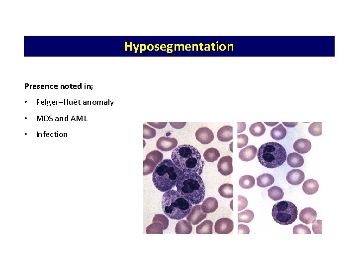 Hyposegmentation Presence noted in; • Pelger–Huët anomaly • MDS and AML • Infection 