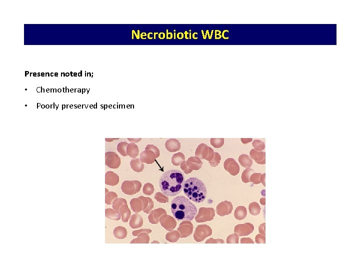 Necrobiotic WBC Presence noted in; • Chemotherapy • Poorly preserved specimen 