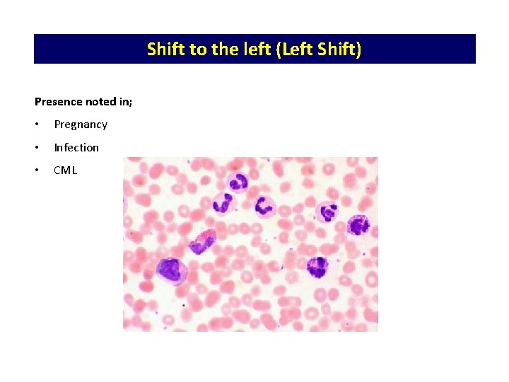 Shift to the left (Left Shift) Presence noted in; • Pregnancy • Infection •