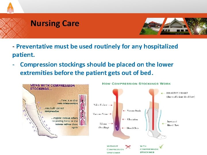 Nursing Care - Preventative must be used routinely for any hospitalized patient. - Compression