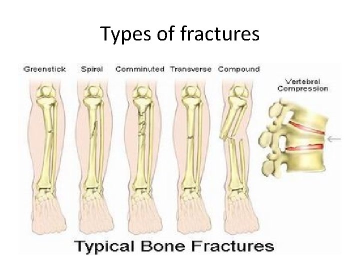 Types of fractures 