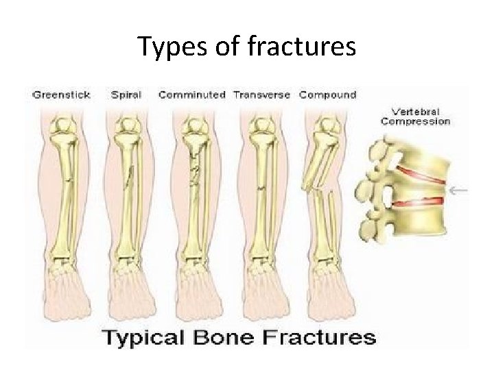 Types of fractures 