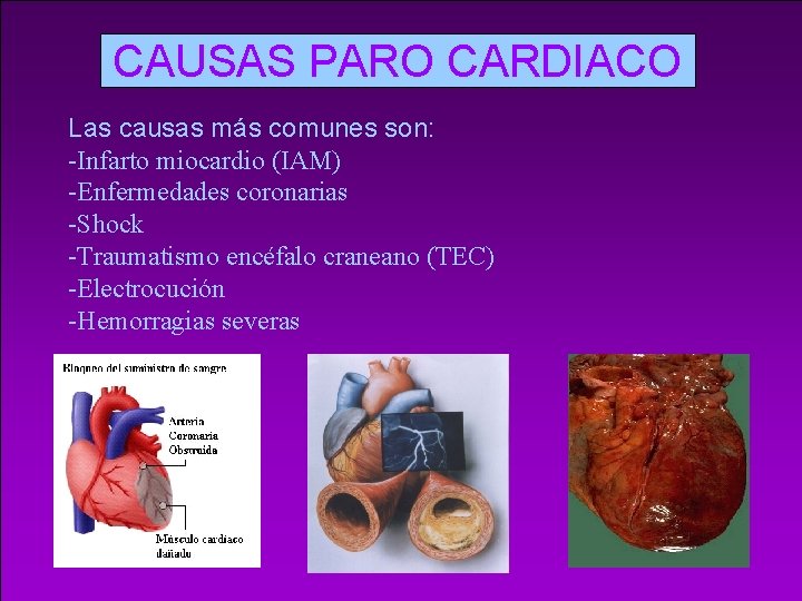 CAUSAS PARO CARDIACO Las causas más comunes son: -Infarto miocardio (IAM) -Enfermedades coronarias -Shock