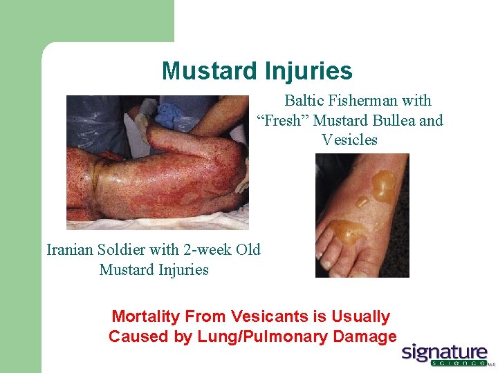 Mustard Injuries A Baltic Fisherman with “Fresh” Mustard Bullea and Vesicles Iranian Soldier with