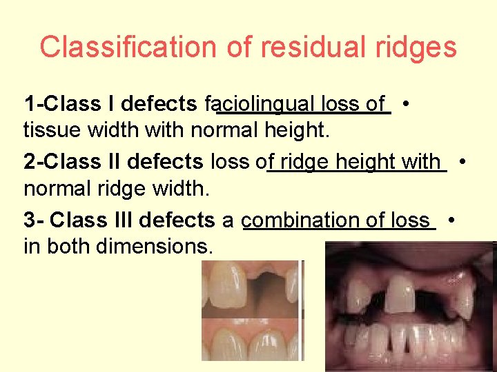 Classification of residual ridges 1 -Class I defects faciolingual loss of • tissue width